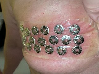 Verwijdering fore punaises uit de tieten