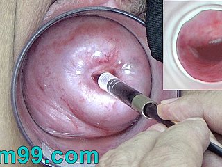 กล้อง Endoscope ญี่ปุ่นภายในปากมดลูกผ่านกล้องเข้าไปในช่องคลอด