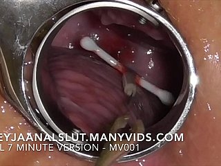 มือสมัครเล่น Freyjaanalslut: การลบ IUD ของเธอ - ดึงมันออกมาจากปากมดลูกของ Freyja ทำให้เธออุดมสมบูรณ์อีกครั้ง - เวอร์ชั่นเต็มใน Mansvids